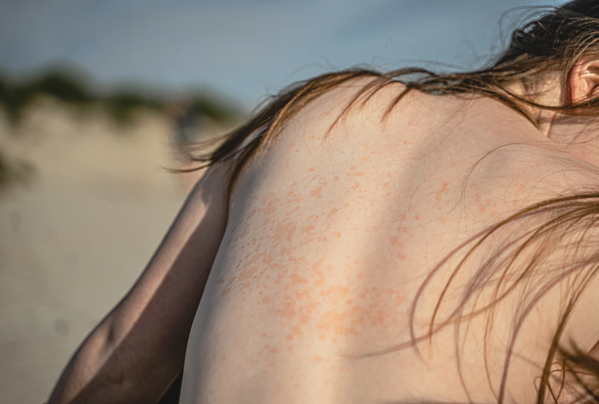 peau sensible sous la chaleur